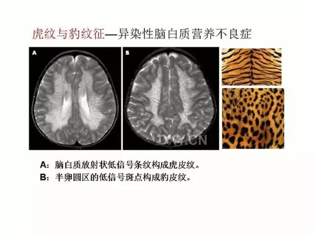 神经影像征象解析