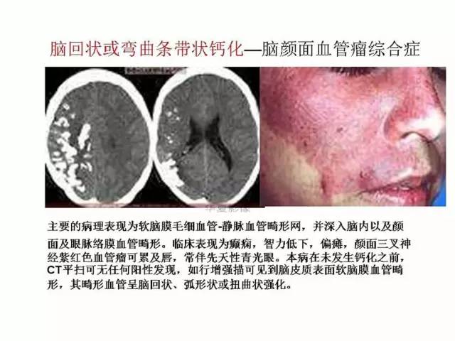 神经影像征象解析