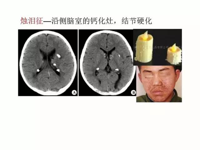 神经影像征象解析