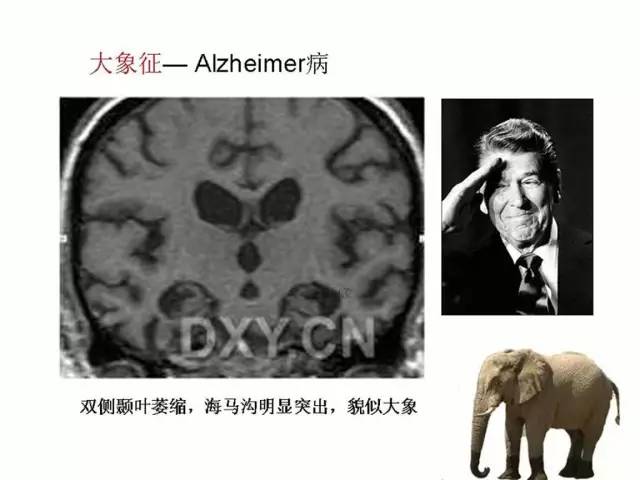 神经影像征象解析