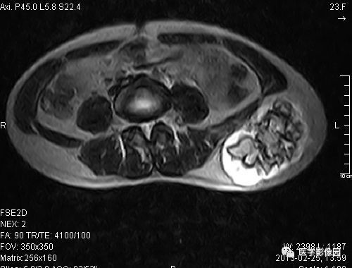 【病例】左髂骨软骨肉瘤1例X线MR影像表现