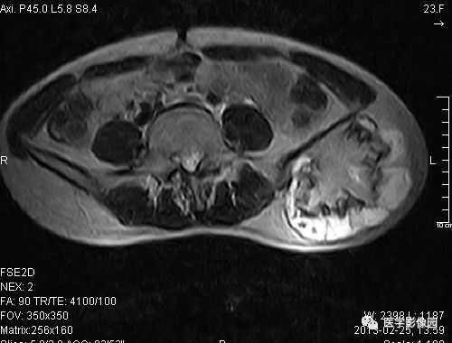 【病例】左髂骨软骨肉瘤1例X线MR影像表现