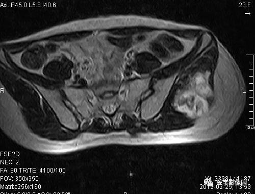 【病例】左髂骨软骨肉瘤1例X线MR影像表现