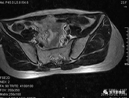 【病例】左髂骨软骨肉瘤1例X线MR影像表现