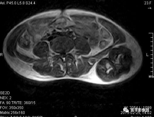 【病例】左髂骨软骨肉瘤1例X线MR影像表现