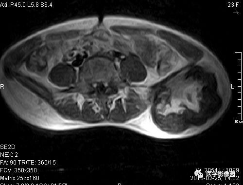 【病例】左髂骨软骨肉瘤1例X线MR影像表现