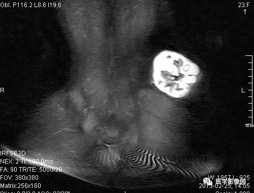 【病例】左髂骨软骨肉瘤1例X线MR影像表现