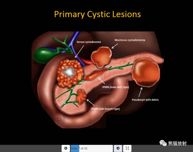 【PPT】胰腺囊性病变的病理分型、MRI表现及鉴别诊断 【PPT】胰腺囊性病变的病理分型、MRI表现及鉴别诊断