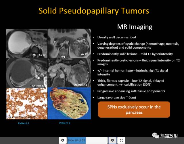 【PPT】胰腺囊性病变的病理分型、MRI表现及鉴别诊断 【PPT】胰腺囊性病变的病理分型、MRI表现及鉴别诊断