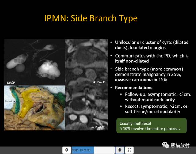 【PPT】胰腺囊性病变的病理分型、MRI表现及鉴别诊断 【PPT】胰腺囊性病变的病理分型、MRI表现及鉴别诊断
