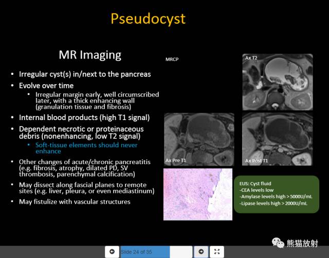 【PPT】胰腺囊性病变的病理分型、MRI表现及鉴别诊断 【PPT】胰腺囊性病变的病理分型、MRI表现及鉴别诊断