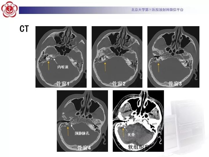 【病例】右侧颞骨内淋巴囊肿瘤1例CT及MR