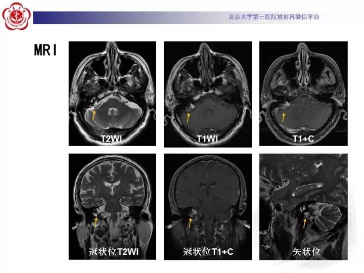 【病例】右侧颞骨内淋巴囊肿瘤1例CT及MR
