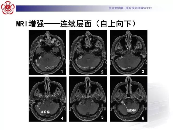 【病例】右侧颞骨内淋巴囊肿瘤1例CT及MR