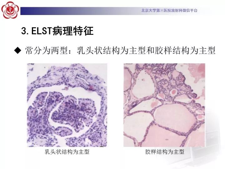 【病例】右侧颞骨内淋巴囊肿瘤1例CT及MR