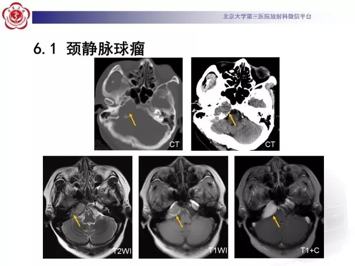 【病例】右侧颞骨内淋巴囊肿瘤1例CT及MR