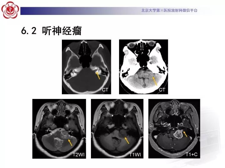 【病例】右侧颞骨内淋巴囊肿瘤1例CT及MR