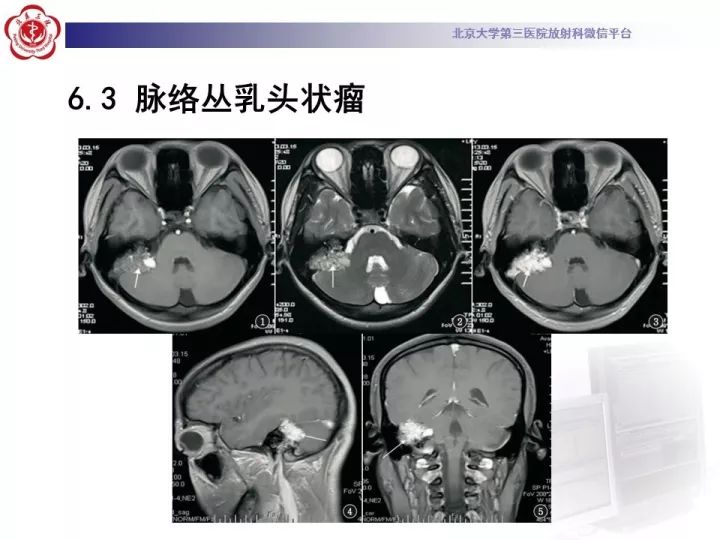 【病例】右侧颞骨内淋巴囊肿瘤1例CT及MR