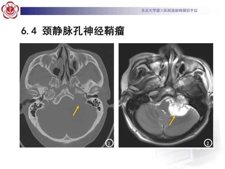 【病例】右侧颞骨内淋巴囊肿瘤1例CT及MR