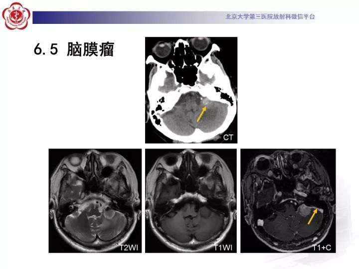 【病例】右侧颞骨内淋巴囊肿瘤1例CT及MR
