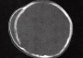 【病例】右顶骨颅外慢性骨膜下血肿机化1例CT 【病例】右顶骨颅外慢性骨膜下血肿机化1例CT