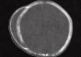 【病例】右顶骨颅外慢性骨膜下血肿机化1例CT 【病例】右顶骨颅外慢性骨膜下血肿机化1例CT