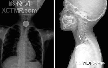 【病例】食管异物1例X线影像诊断分析