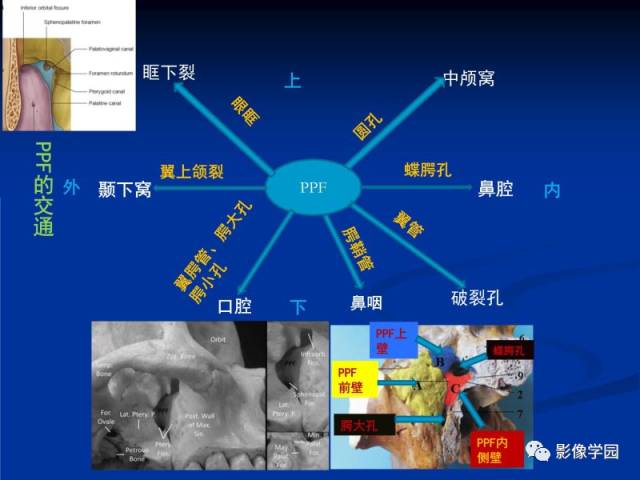 【PPT】翼腭窝PPF的解剖及影像学评价