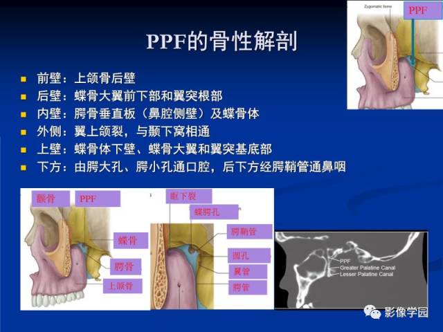 【PPT】翼腭窝PPF的解剖及影像学评价