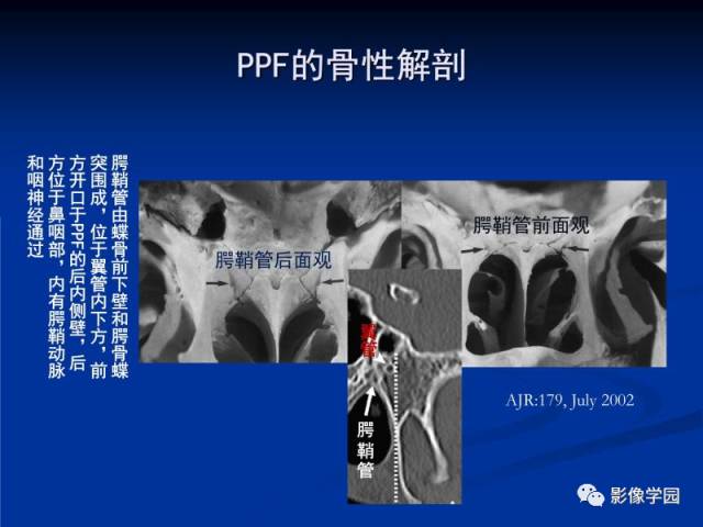 【PPT】翼腭窝PPF的解剖及影像学评价