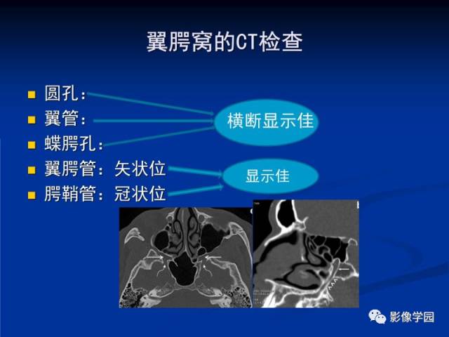 【PPT】翼腭窝PPF的解剖及影像学评价