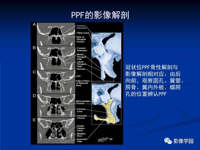 【PPT】翼腭窝PPF的解剖及影像学评价