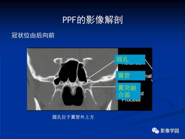 【PPT】翼腭窝PPF的解剖及影像学评价