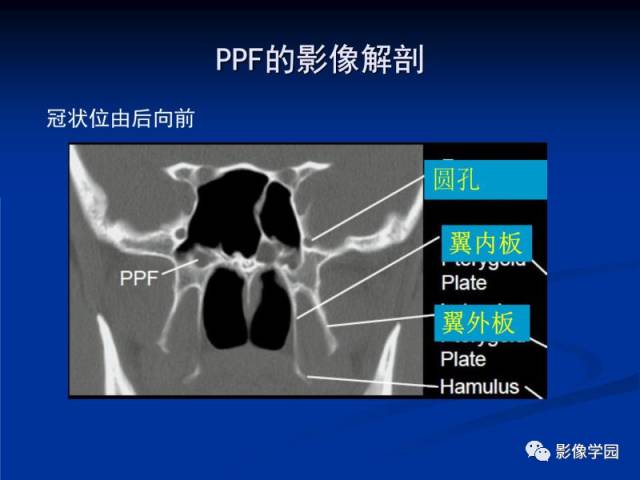 【PPT】翼腭窝PPF的解剖及影像学评价