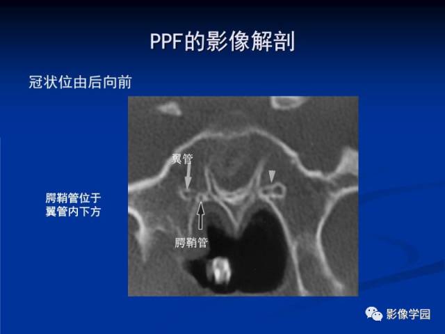 【PPT】翼腭窝PPF的解剖及影像学评价