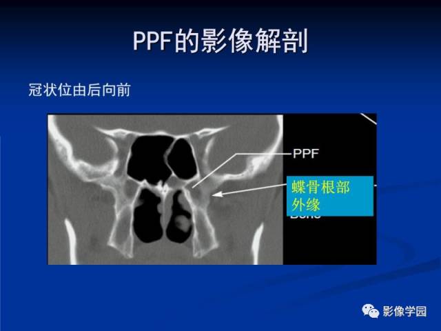 【PPT】翼腭窝PPF的解剖及影像学评价