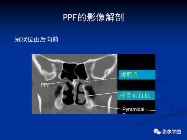 【PPT】翼腭窝PPF的解剖及影像学评价