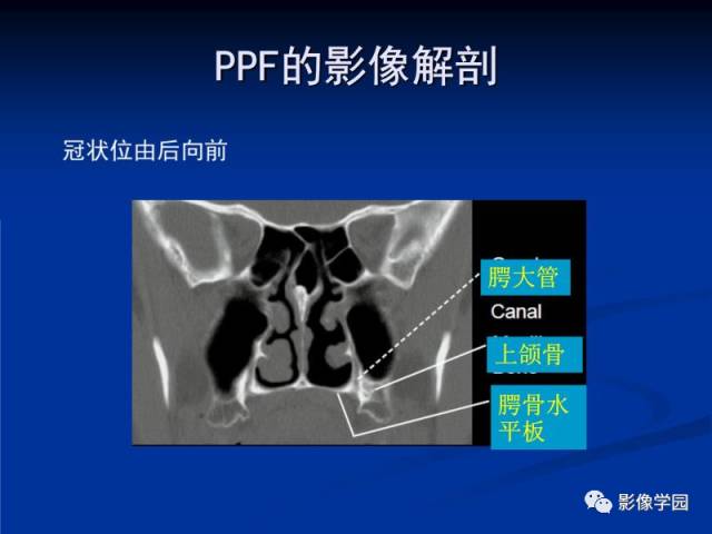 【PPT】翼腭窝PPF的解剖及影像学评价