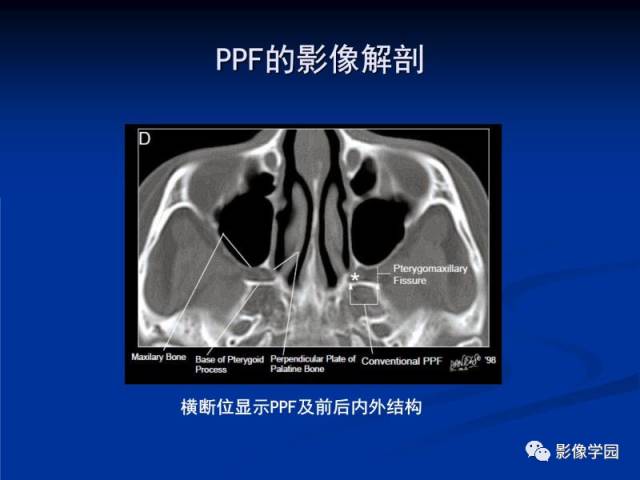 【PPT】翼腭窝PPF的解剖及影像学评价