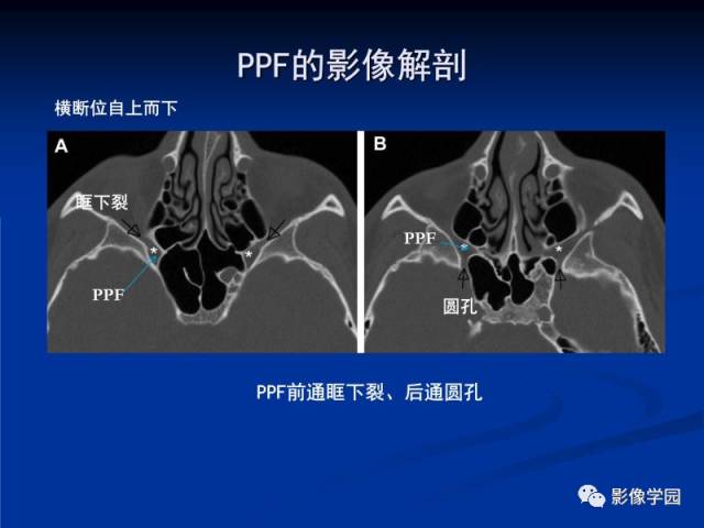 【PPT】翼腭窝PPF的解剖及影像学评价