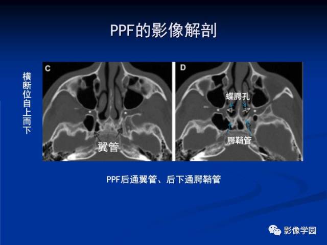 【PPT】翼腭窝PPF的解剖及影像学评价