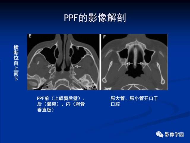 【PPT】翼腭窝PPF的解剖及影像学评价