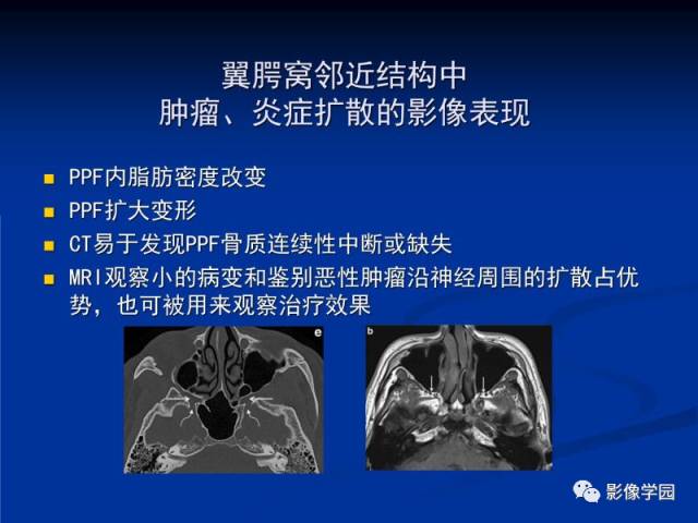 【PPT】翼腭窝PPF的解剖及影像学评价
