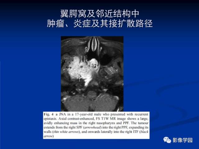 【PPT】翼腭窝PPF的解剖及影像学评价