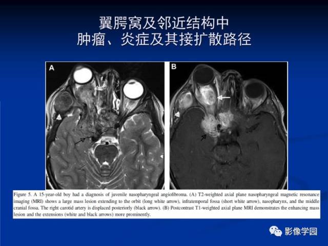 【PPT】翼腭窝PPF的解剖及影像学评价