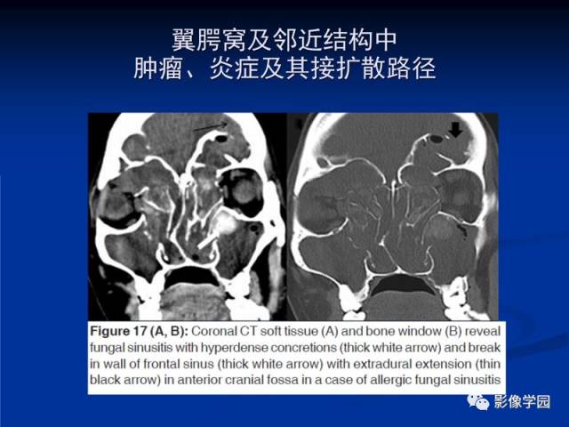【PPT】翼腭窝PPF的解剖及影像学评价
