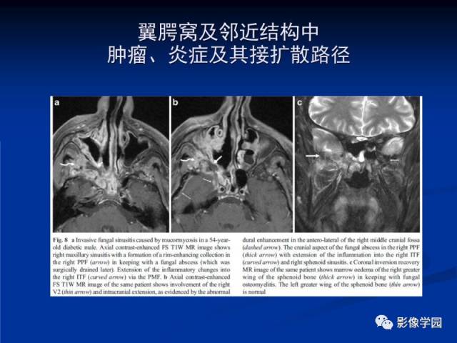 【PPT】翼腭窝PPF的解剖及影像学评价