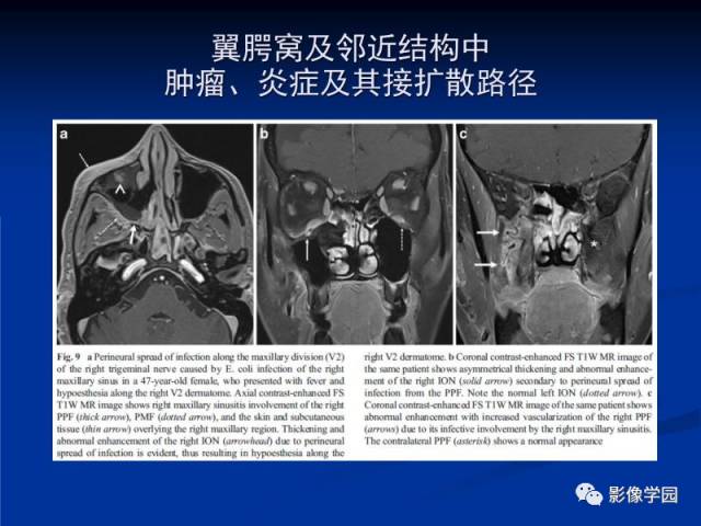 【PPT】翼腭窝PPF的解剖及影像学评价