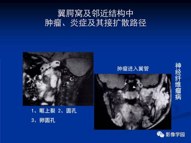 【PPT】翼腭窝PPF的解剖及影像学评价