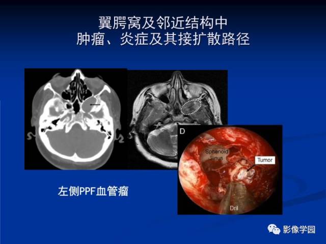 【PPT】翼腭窝PPF的解剖及影像学评价